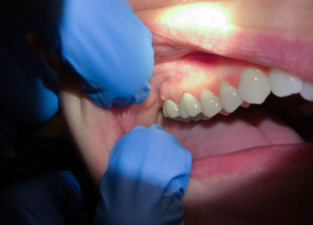 Best Emergency Treatment for Dental Infections or Abscesses in Arthurtown, SC